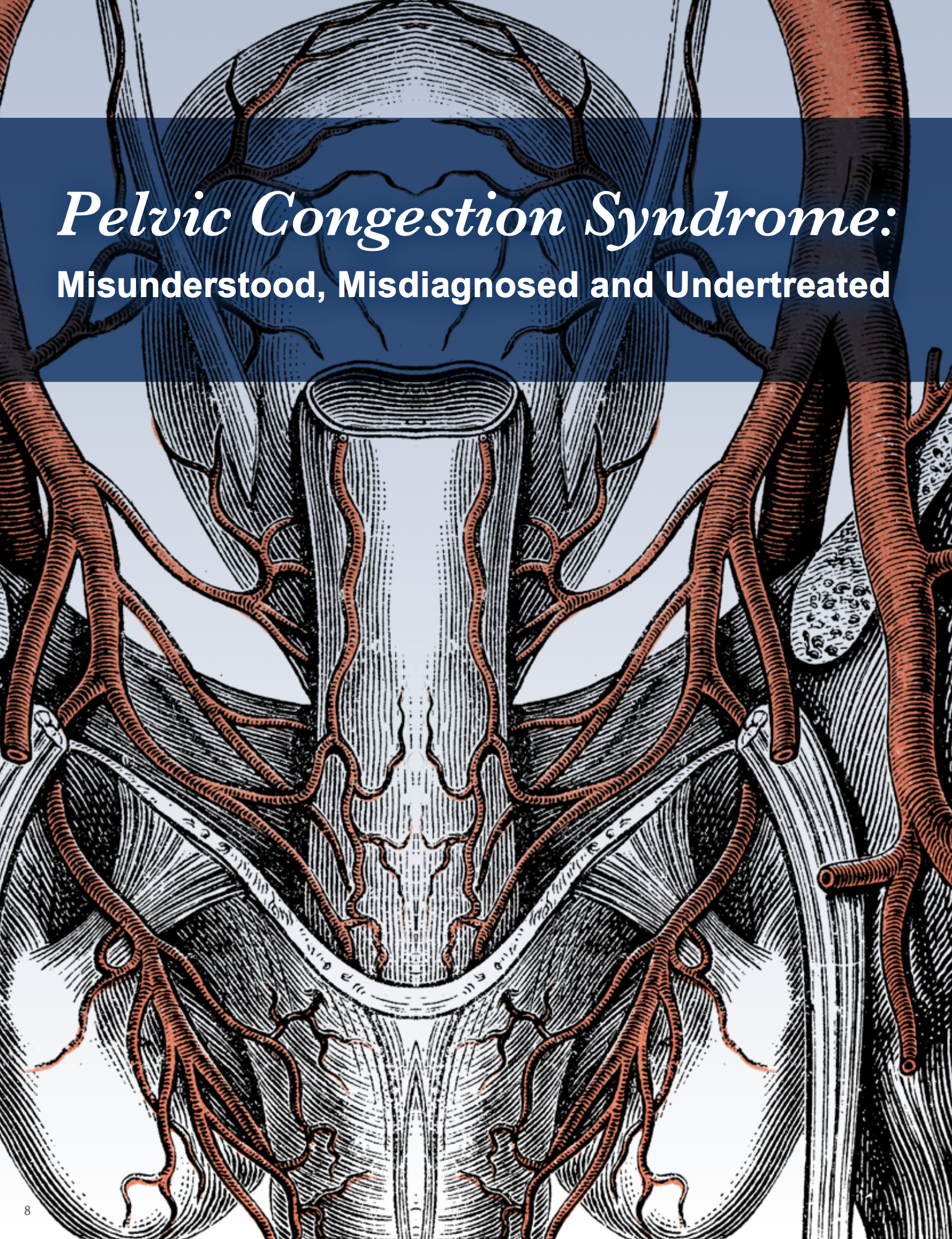 Pelvic congestion syndrome